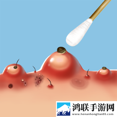 粉刺达人